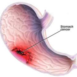 Stomach gastric cancer