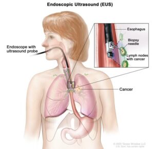 Endoscopic Ultrasonography (EUS)